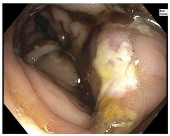 Colonoscopic view of the colo-colonic anastomosis demonstrating erythema and superficial erosion without active intraluminal bleeding. Image Obtained using a standard adult colonoscope (Outer diameter approximately 12 mm) providing an approximate visual scale.