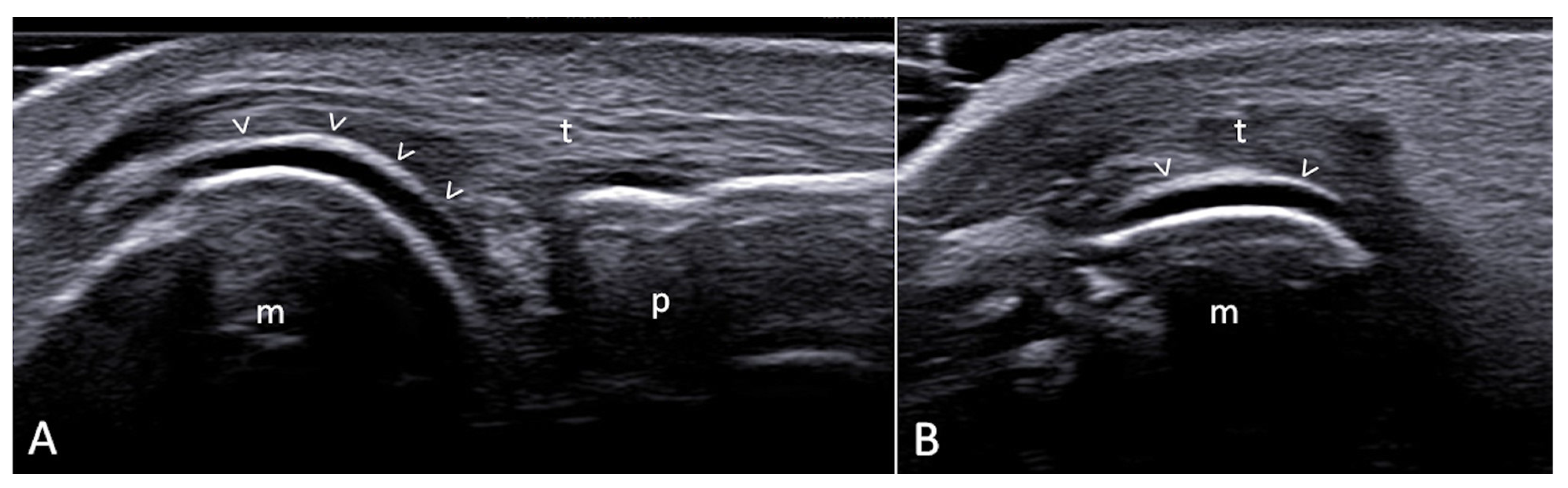 Optimising the Use of Ultrasound in Gout: A Review from the Ground Up ...