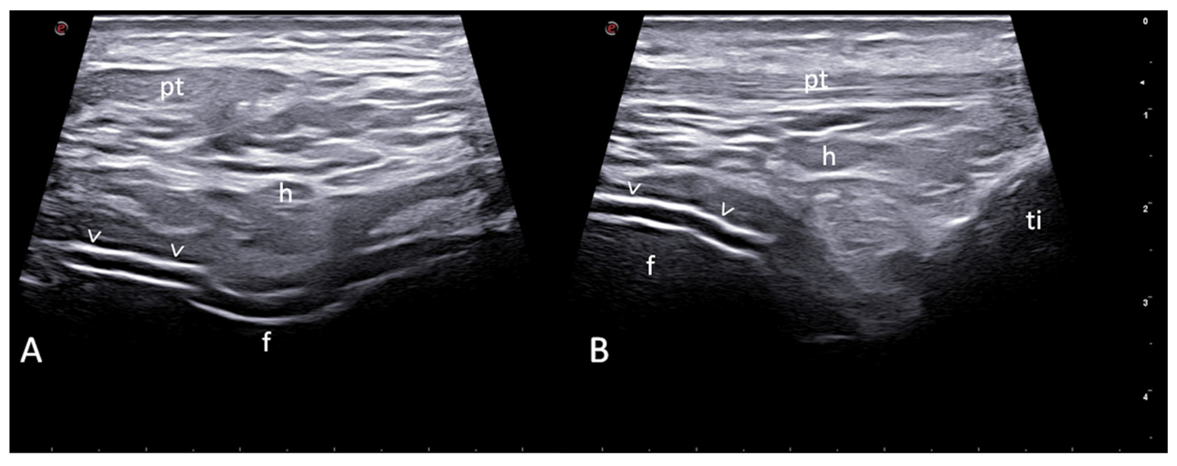 Optimising the Use of Ultrasound in Gout: A Review from the Ground Up ...