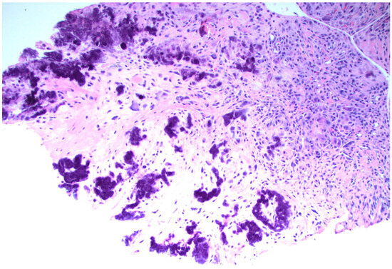 Synovial biopsy sample of calcium pyrophosphate deposition disease (CPPD), stained with hematoxylin and eosin. CPPD crystals are aggregated and appear dark purple. Source: Dr. Ami Ben-Artzi.