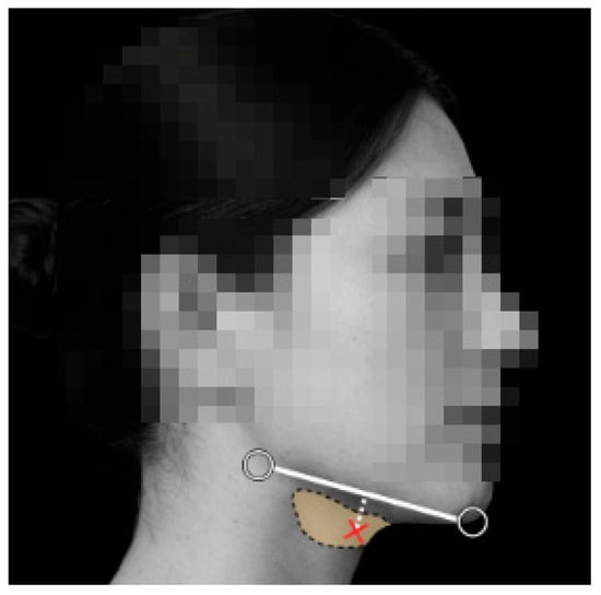 Schematic illustration of the cosmetic BoNT/A injection into the submandibular salivary gland. The shaded area indicates the anatomical location of the submandibular gland beneath the mandible. The injection trajectory (white dotted line) represents an inferior-to-superior approach commonly used in cosmetic practice, with the red cross marking the injection site.