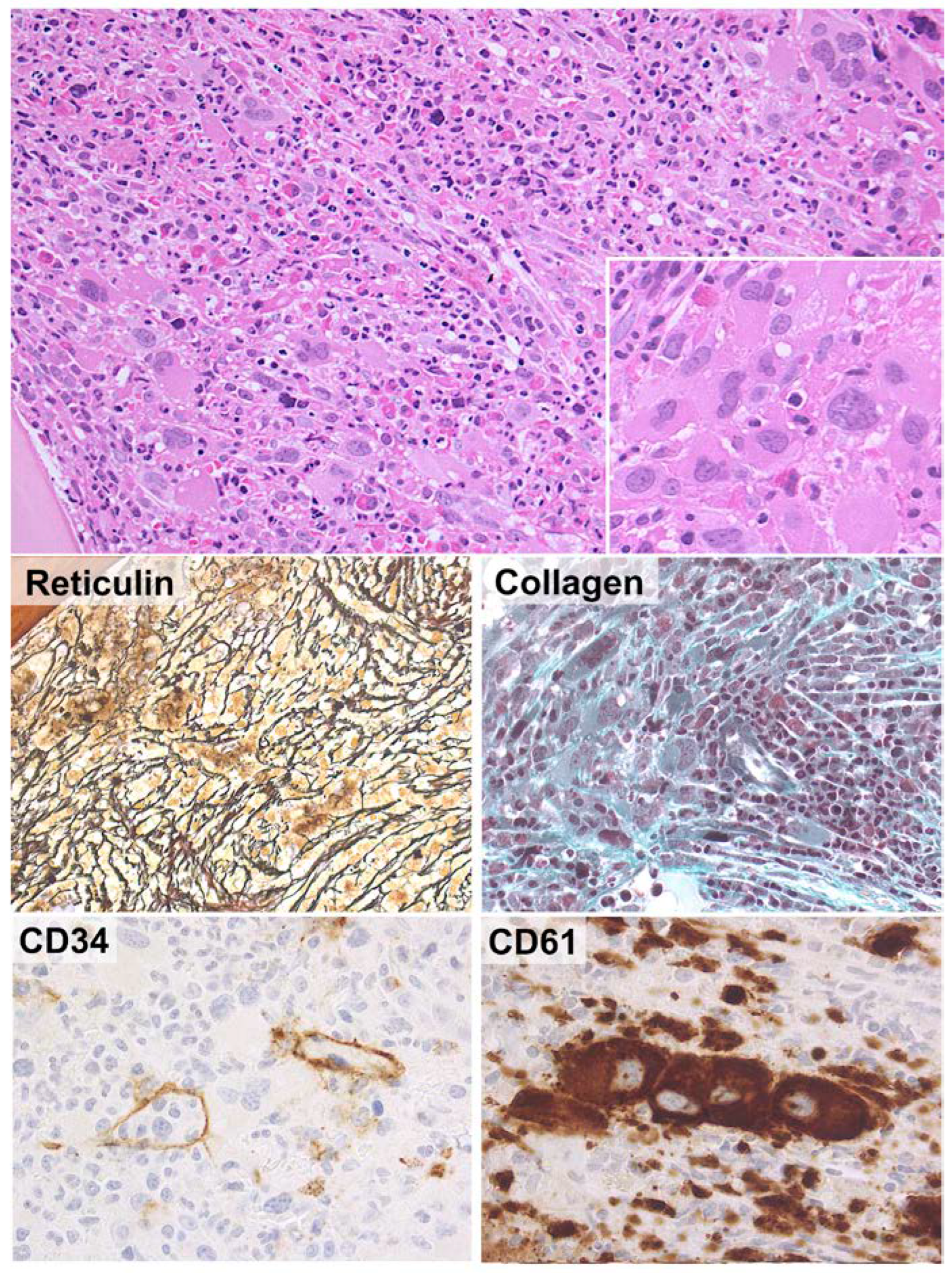 What’s New in the Classification, Diagnosis and Therapy of Myeloid ...
