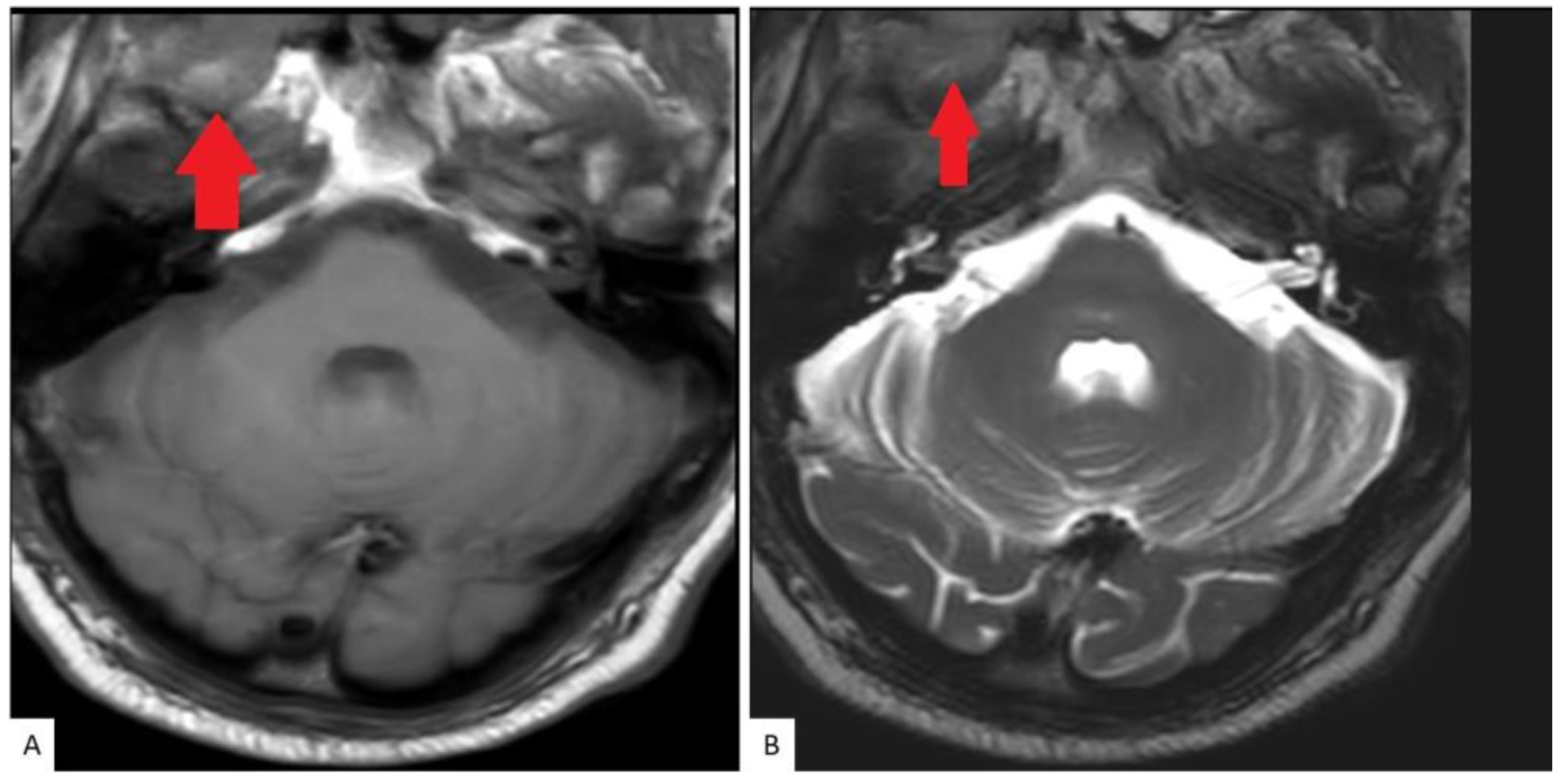 Hematolrep 15 00007 g003 Hematolrep 15 00007 g003