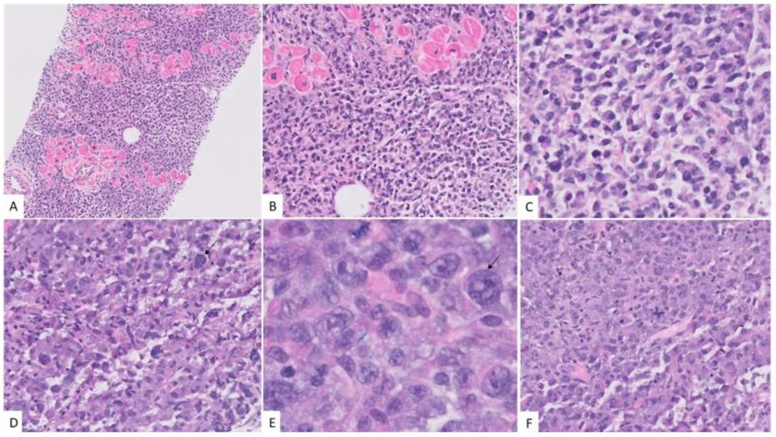 Hematolrep 15 00007 g004 Hematolrep 15 00007 g004