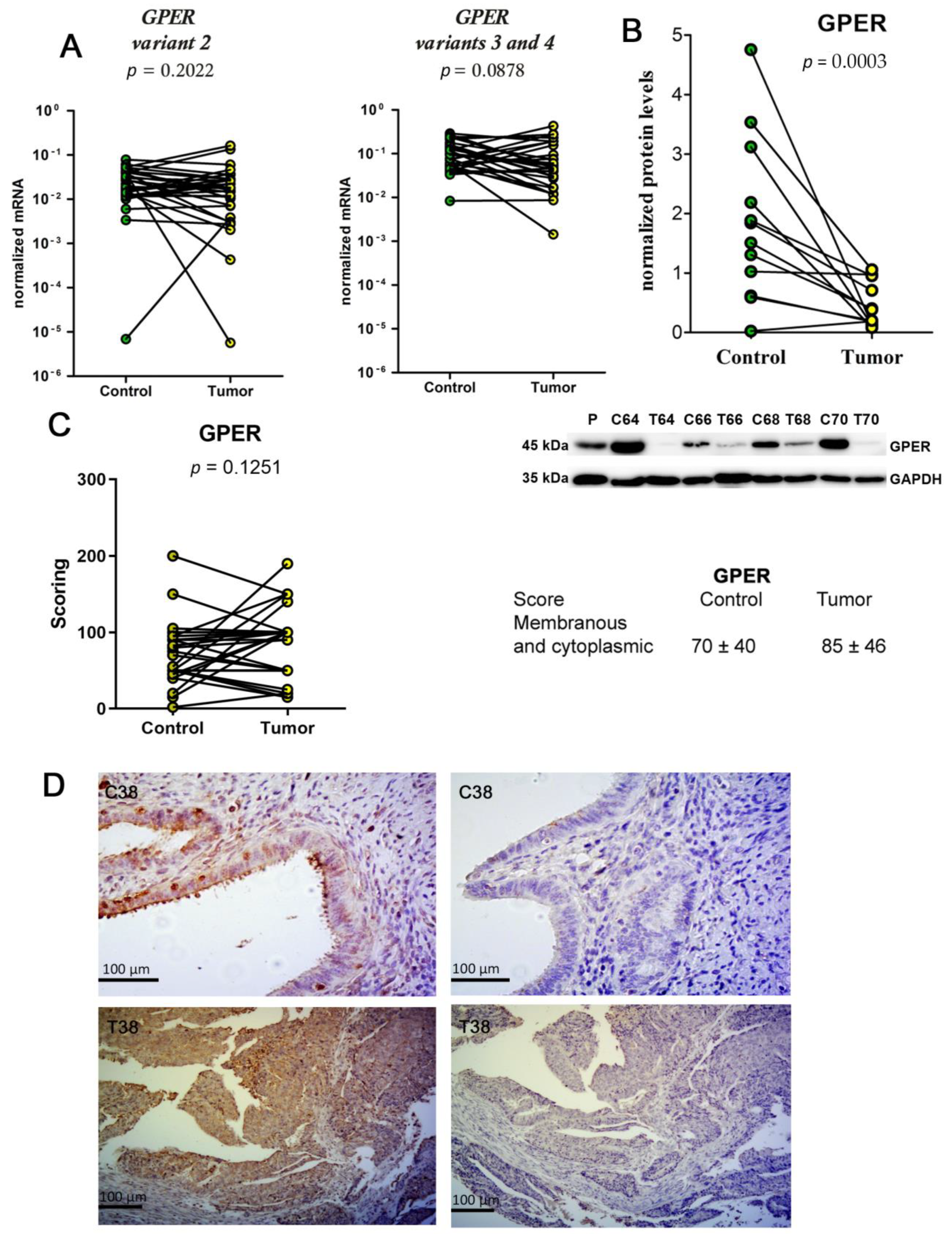 The Co-Expression of Estrogen Receptors ERα, ERβ, and GPER in ...