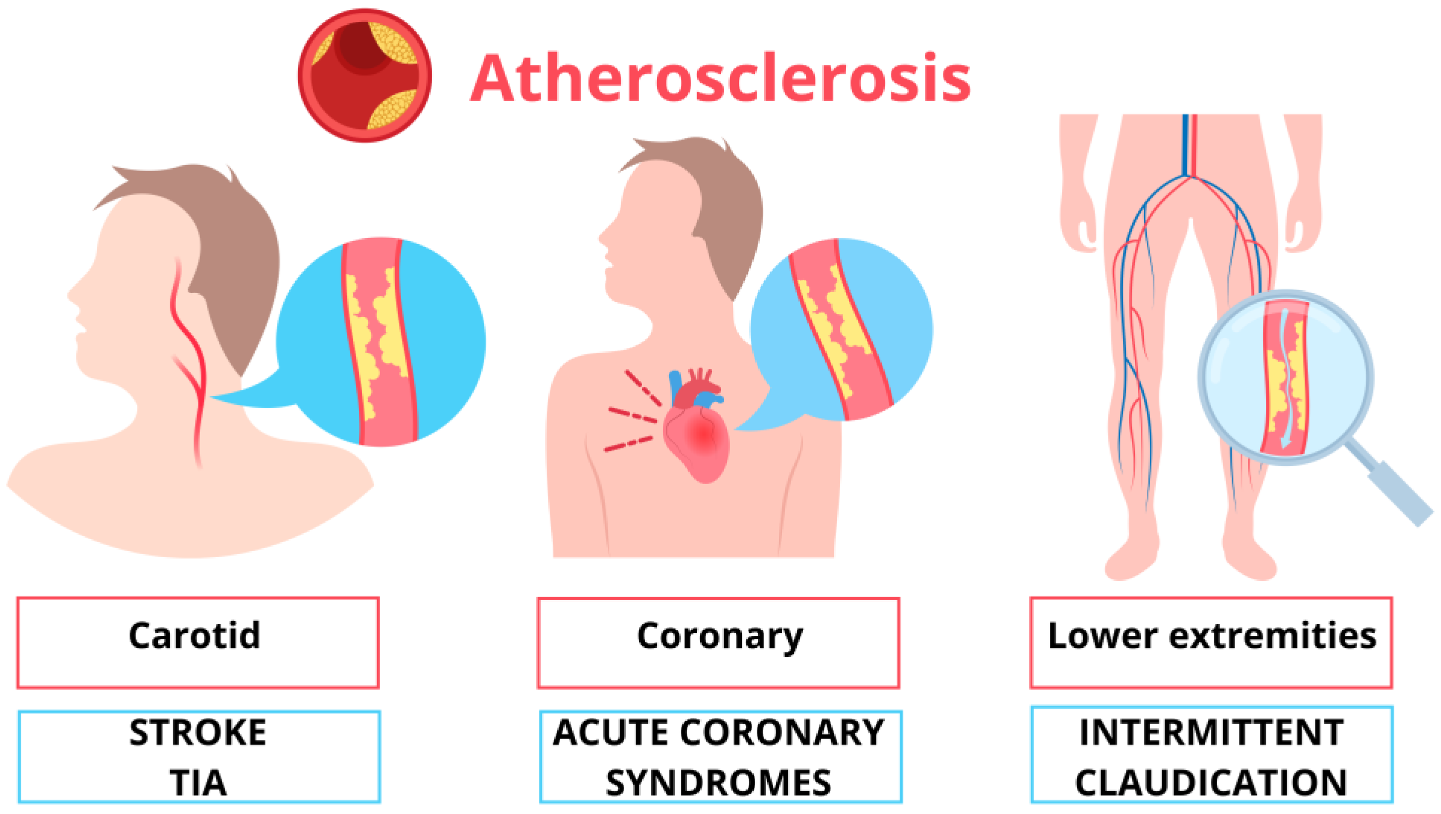 Discovering Inflammation in Atherosclerosis: Insights from Pathogenic ...