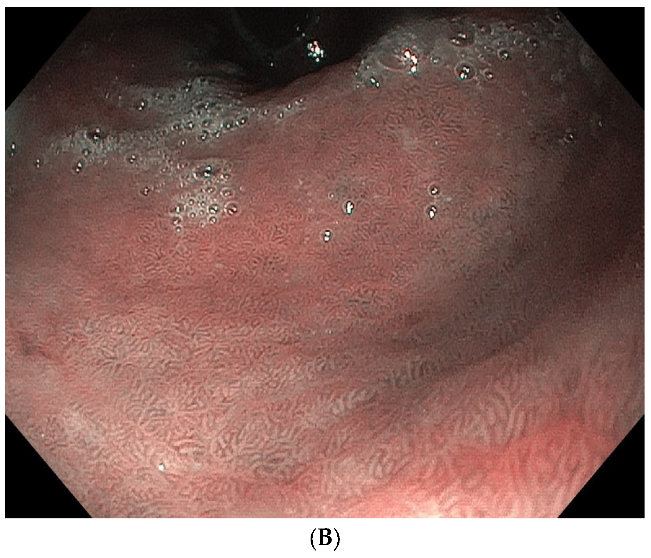 Autoimmune Gastritis And Hypochlorhydria Known Concepts From A New Autoimmune Gastritis And Hypochlorhydria Known Concepts From A New