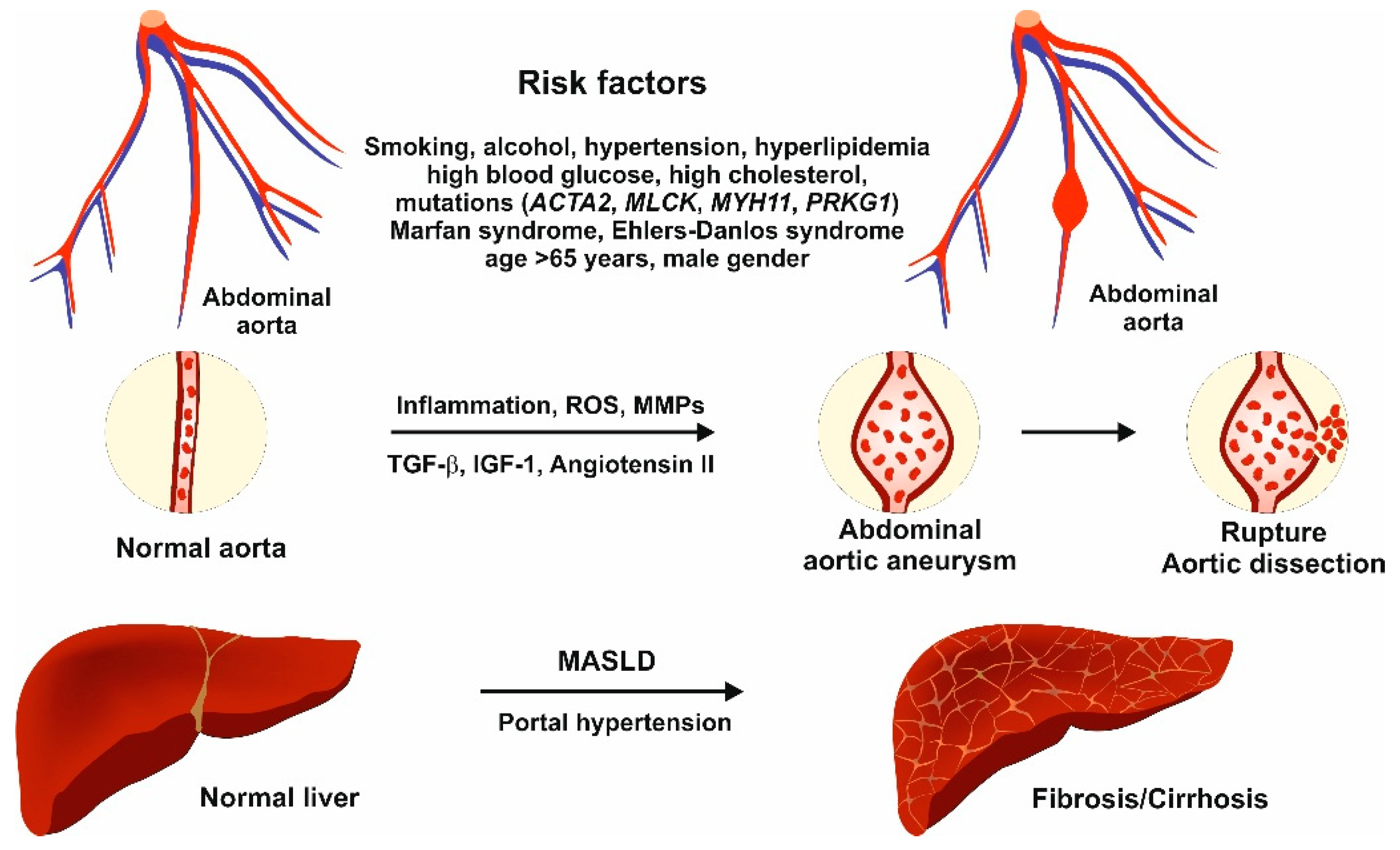 Abdominal Aortic Aneurysm and Liver Fibrosis: Clinical Evidence and ...