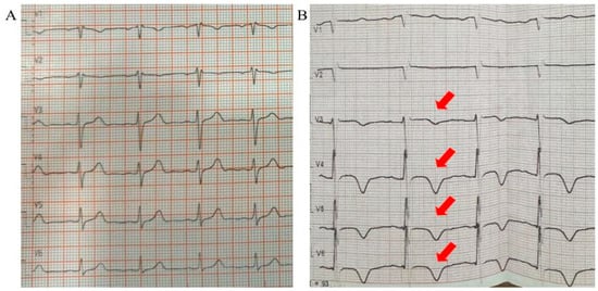 (A) Electrocardiogram on admission; (B) Electrocardiogram at the onset of chest discomfort showing negative T waves in precordial leads V3–V6 (indicated with red arrows).