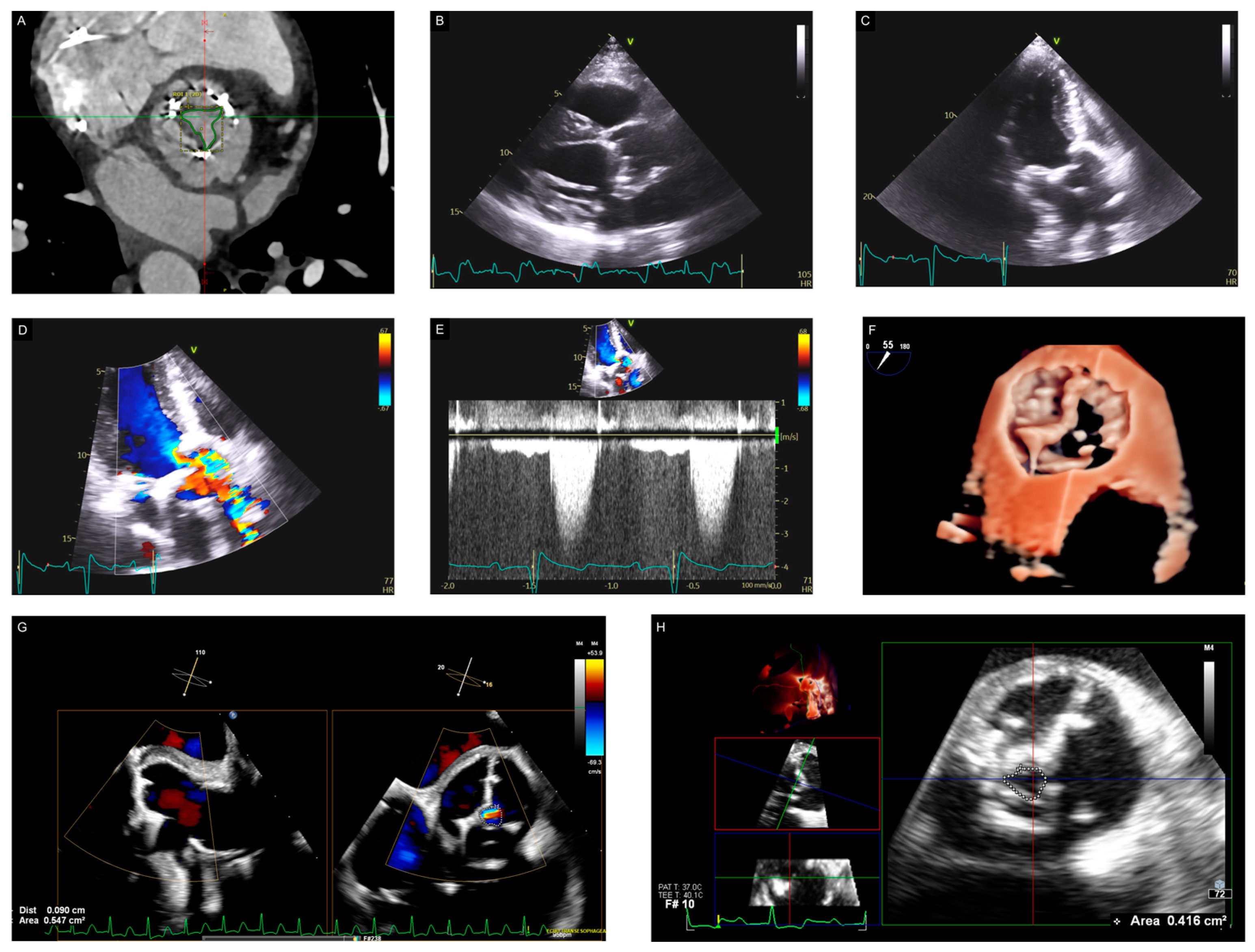 Bioprosthetic Aortic Valve Degeneration After TAVR and SAVR: Incidence ...
