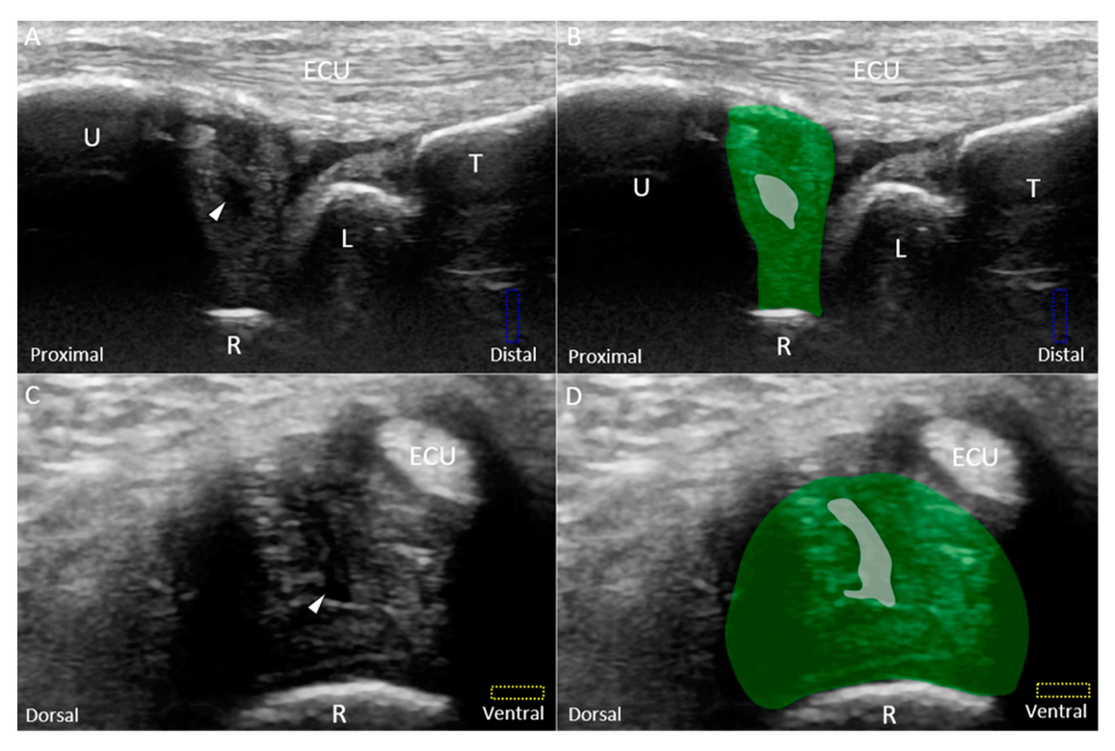 Ulnar Wrist Pain Revisited: Ultrasound Diagnosis and Guided Injection ...