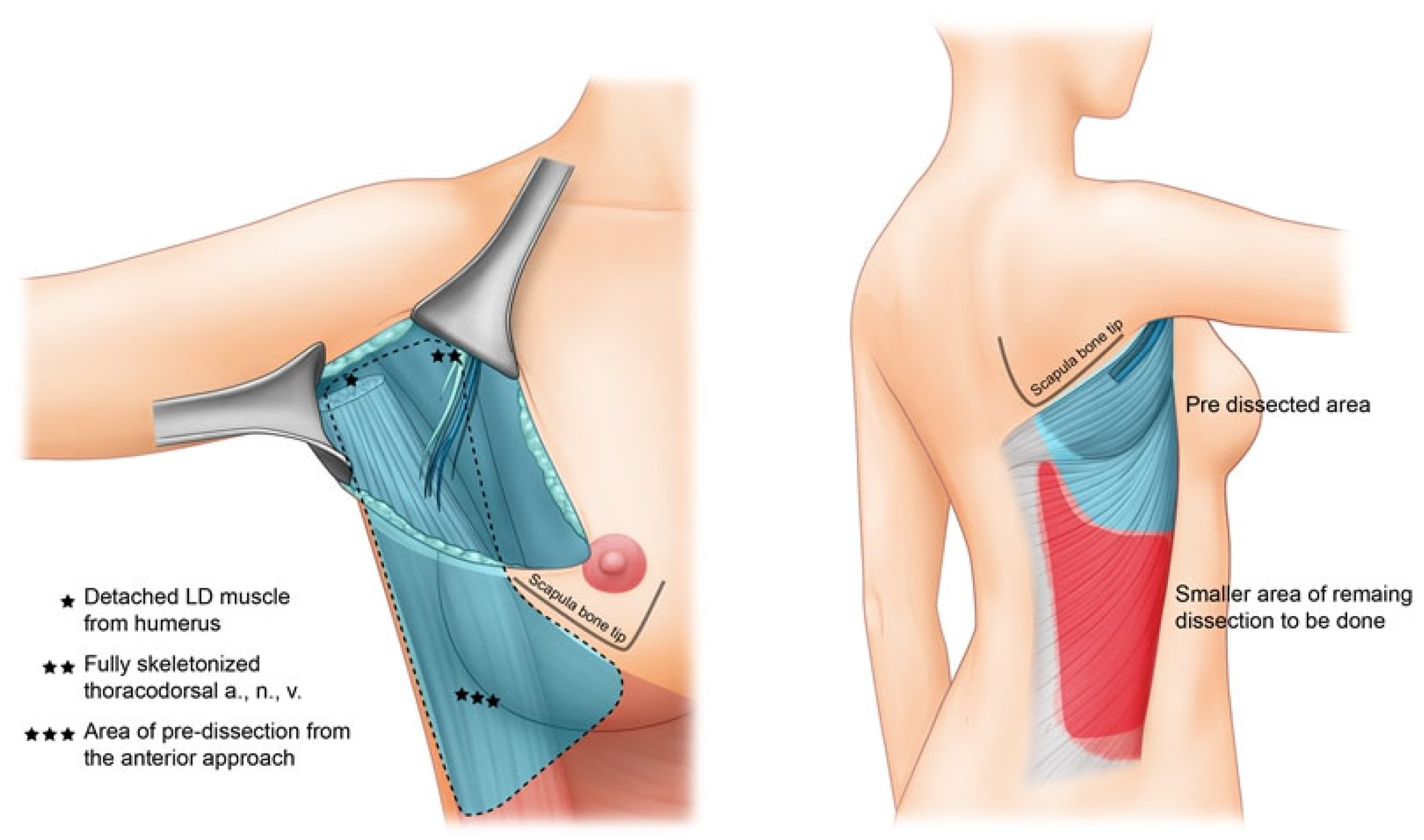 Anterior-First Approach for Latissimus Dorsi Myocutaneous Flap Breast ...