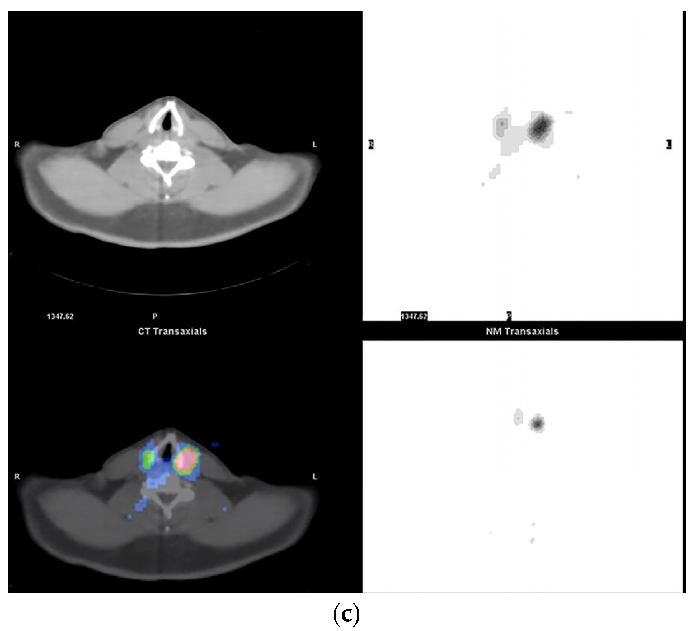 Pre And Post Rai Scan Pre-Treatment and Post-Treatment I-131 Imaging in Differentiated ...