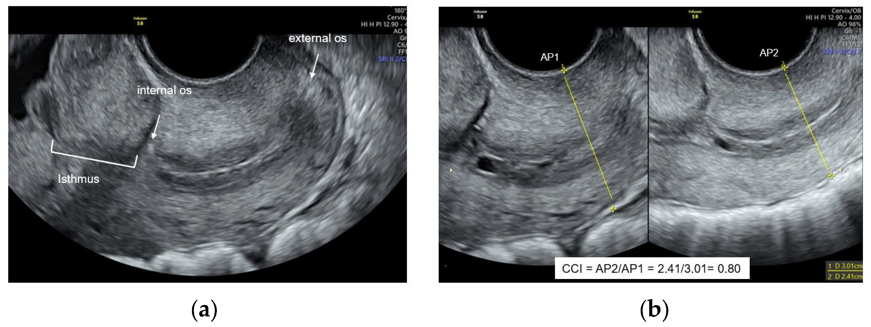 Performance of the First-Trimester Cervical Consistency Index to ...