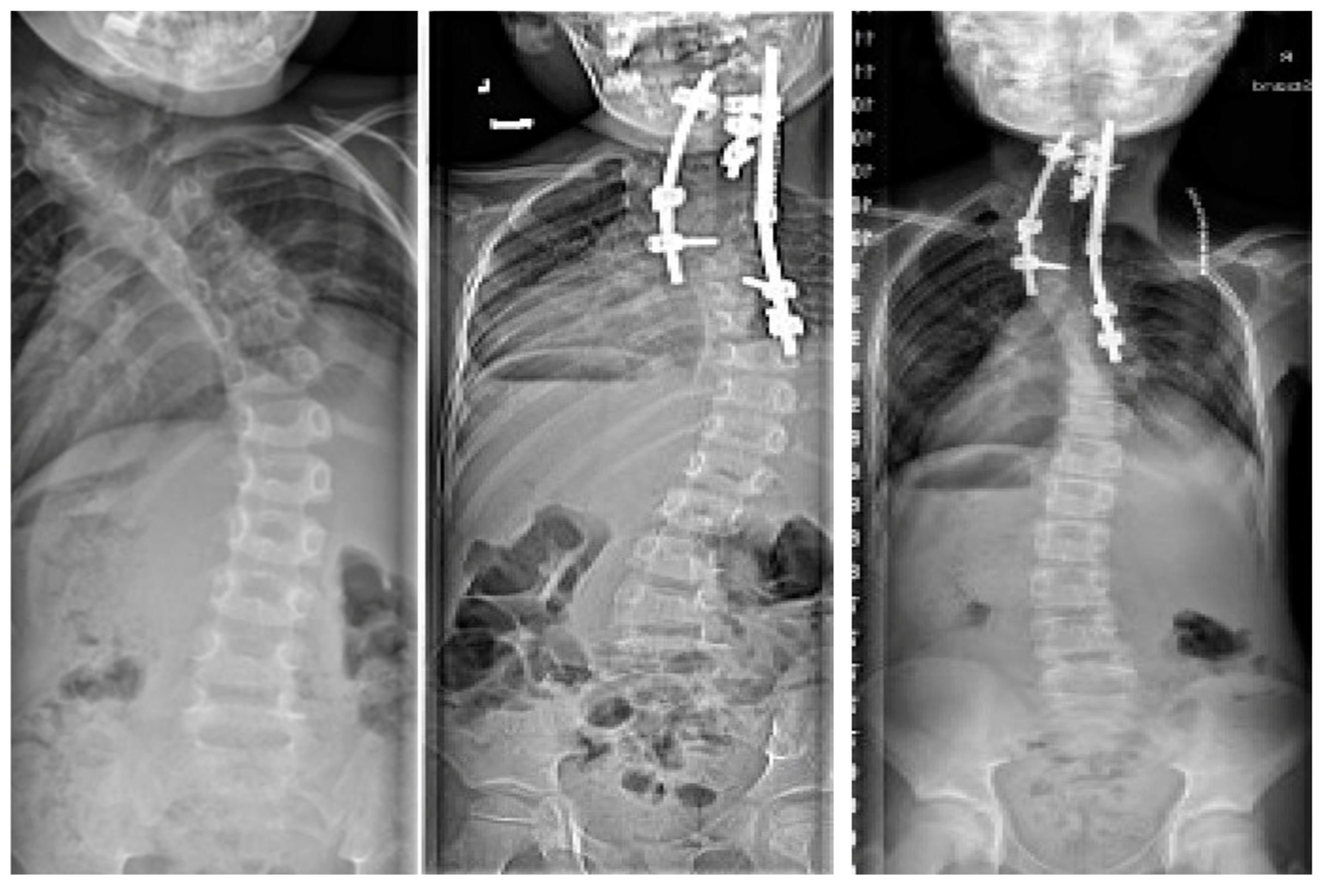 Current Concepts in the Treatment of Early Onset Scoliosis