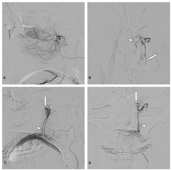 Spa Embolization Superselective Unilateral Embolization of the Sphenopalatine Artery for ...