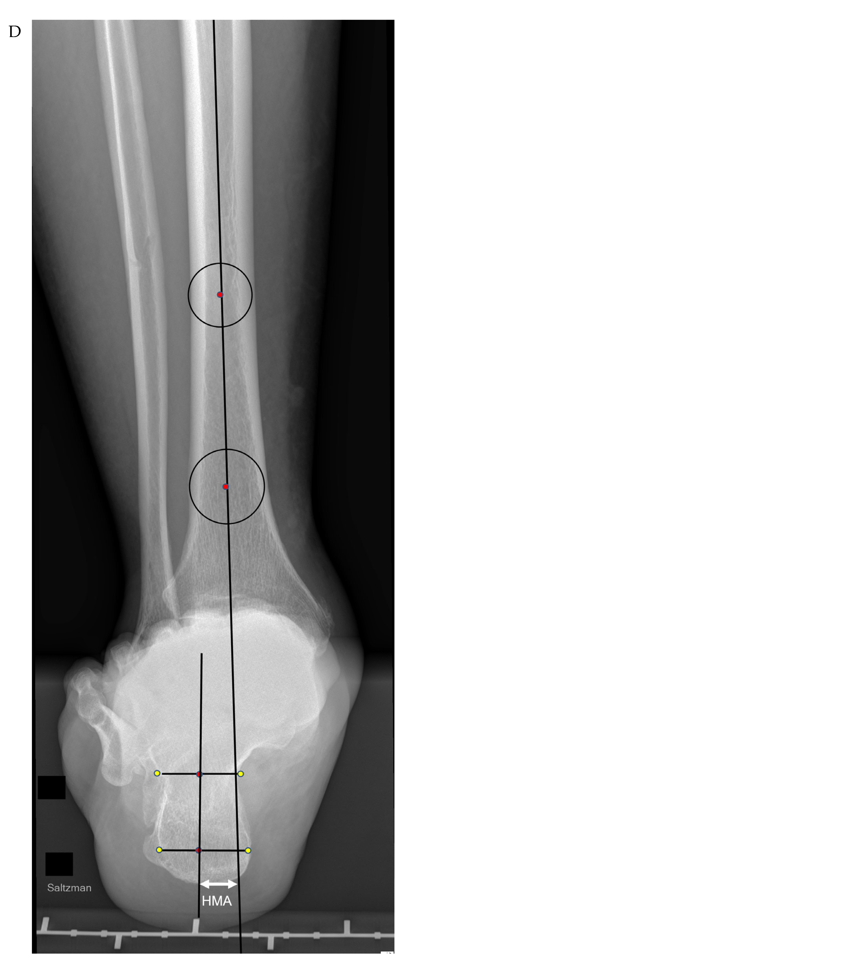 The Impact of Spring Ligament Injuries on Flatfoot Deformity: An ...