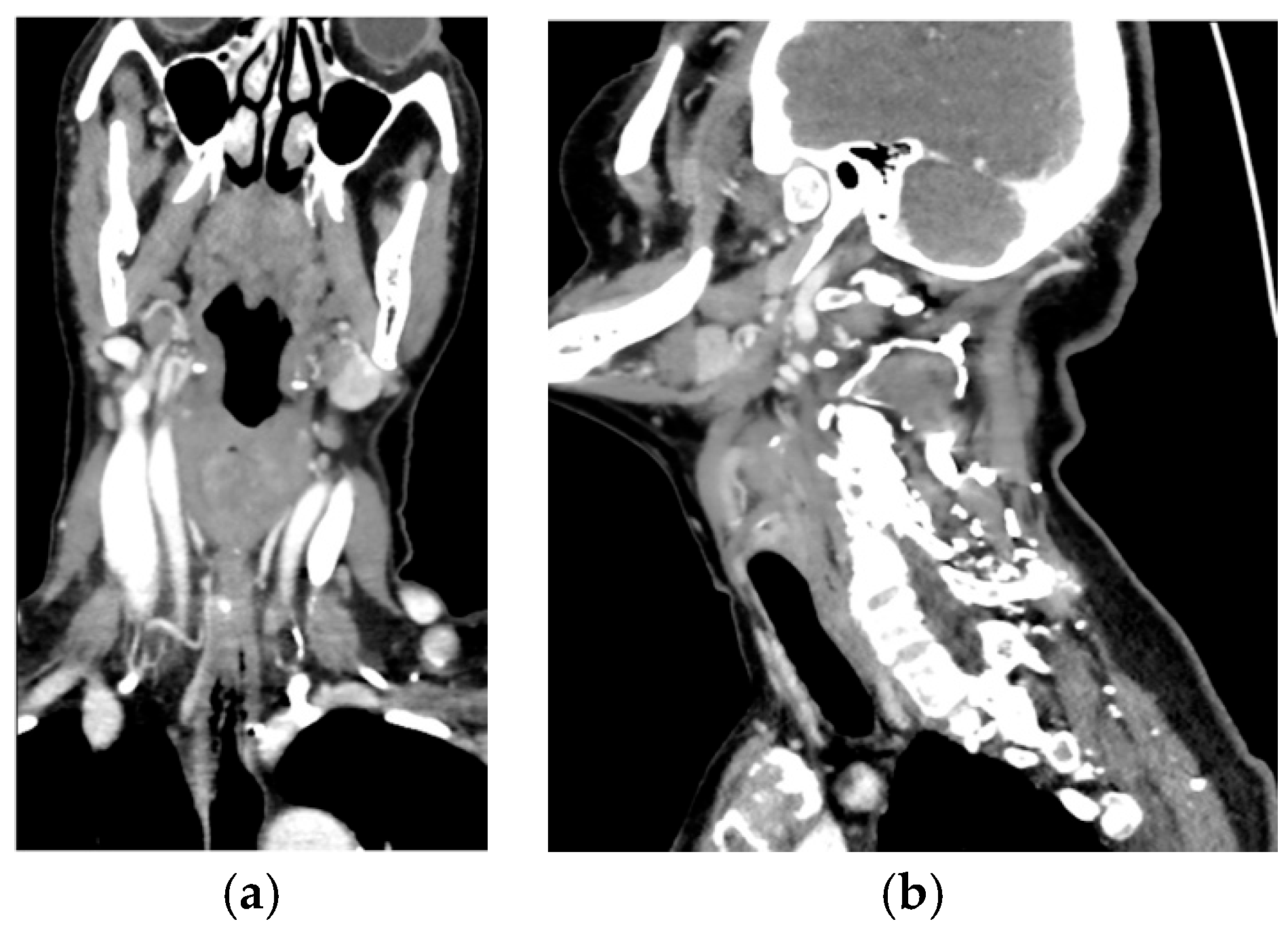 Primary Hyperparathyroidism: 18F-Fluorocholine PET/CT vs. 4D-CT for ...