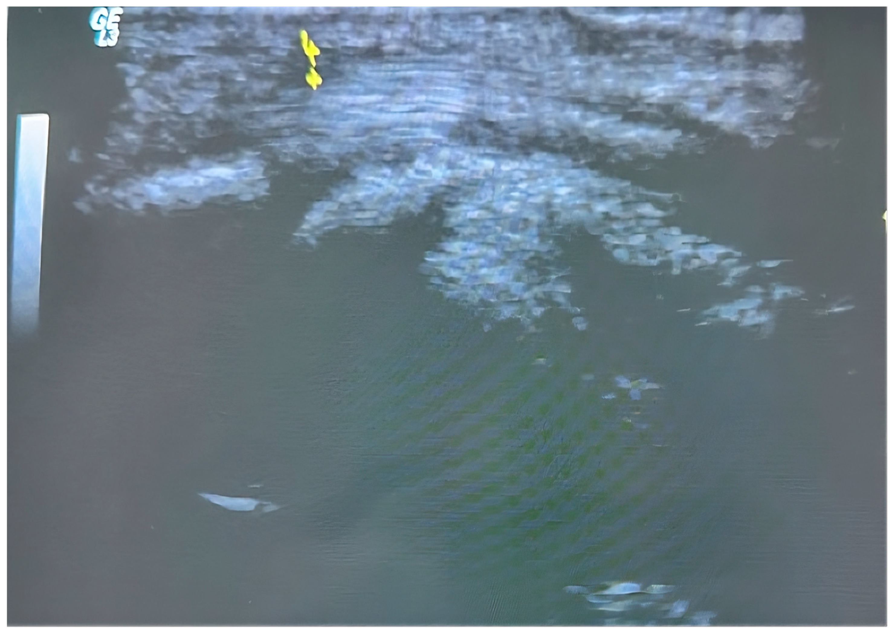 Ultrasound-Guided Percutaneous Versus Open A1 Pulley Release for ...