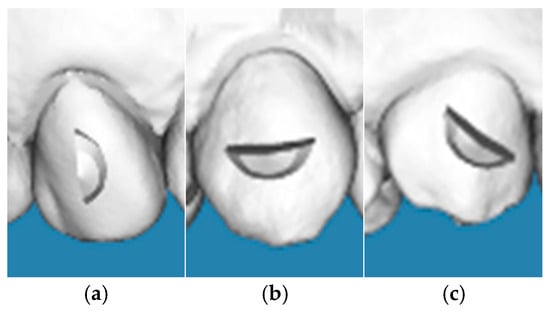Schematic illustration of the crescent-shaped attachment designs and their orientations on the maxillary canine: (a) vertical orientation, (b) horizontal orientation, and (c) oblique orientation. All attachments feature standardized dimensions (3.00 mm height and 1.00 mm thickness) and are positioned at the geometric center of the clinical crown.