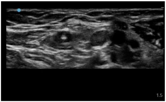 Ultrasound visualization of central intraluminal needle tip position.