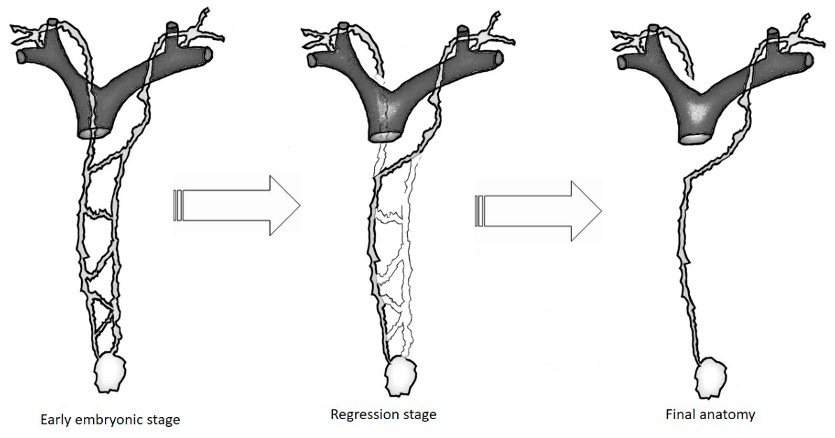 Cervical Chylous Fistula After Lymphadenectomy for Differentiated ...