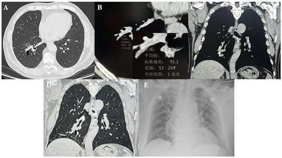 Computed Tomography Features and Diagnostic Pitfalls of Bronchial Chili ...