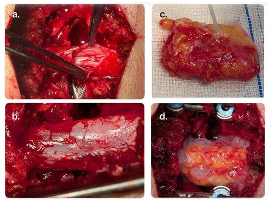 The 4D Repair Technique for Incidental Durotomy in Spine Surgery ...
