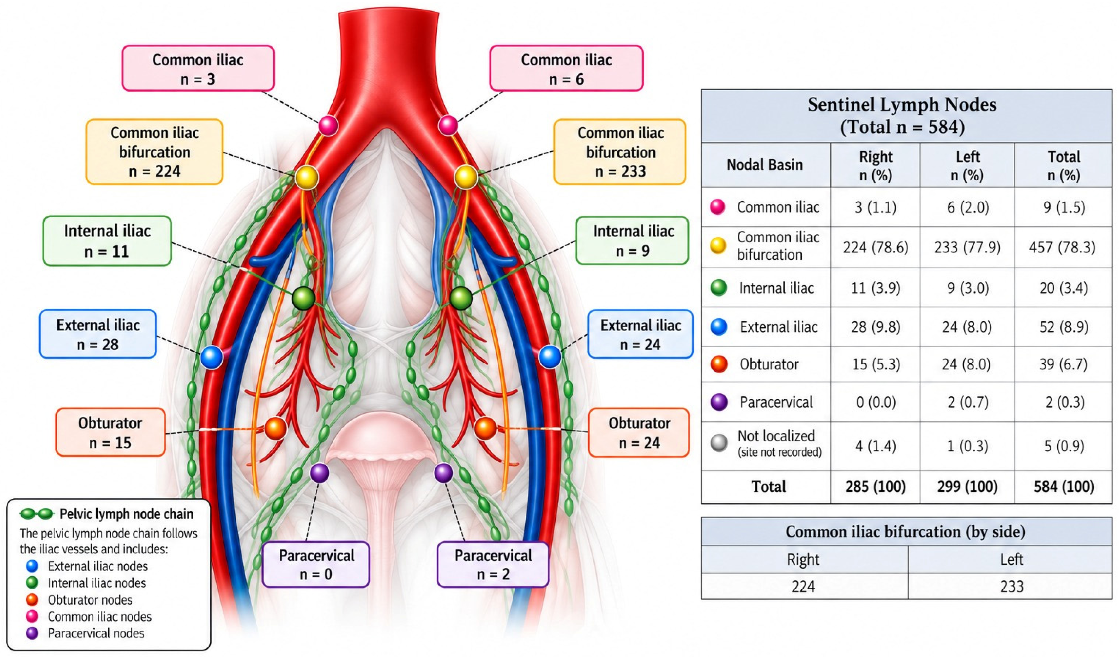 Sentinel Lymph Node Mapping in Endometrial Cancer: Experience from a ...