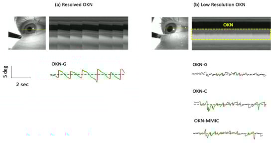Results of automated OKN detection. (a) The Pupil Neon eye-tracker and eye camera video. (b) An example of a stereotypical well-resolved OKN found from a single eye. The figure shows an image from the eye camera with a horizontal line indicating the source of pixels used to form the cross-sectional view. Below the cross-section is the gaze signal obtained from the Pupil Neon eye-tracker, along with automated OKN detection results. The 1D signals are shown with detected slow phases (green) amd quick phases (red) superimposed. (b) Low resolution OKN. In this case, small amplitude/high frequency oscillations were seen in the eye camera video (see cross-sectional view and area within the dashed line). However, these oscillations are not readily apparent using OKN-G. Output from the OKN-C and OKN-MMIC methods reveals additional instances of OKN.