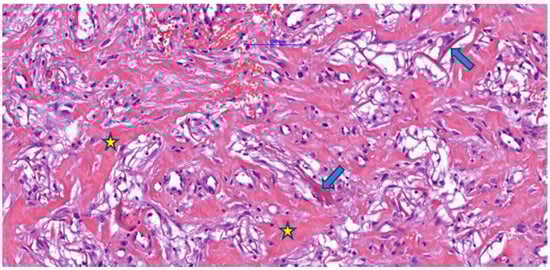 Post-implantation dermal tissue fragments with Integra in the neovascularization phase (weeks 3–4), showing remnants (arrow) of eosinophilic material (Integra) with the formation of numerous collagen fibers (asterisk) associated with a discrete mononuclear inflammatory infiltrate and vascular lumens, some of which contain blood (H&E).