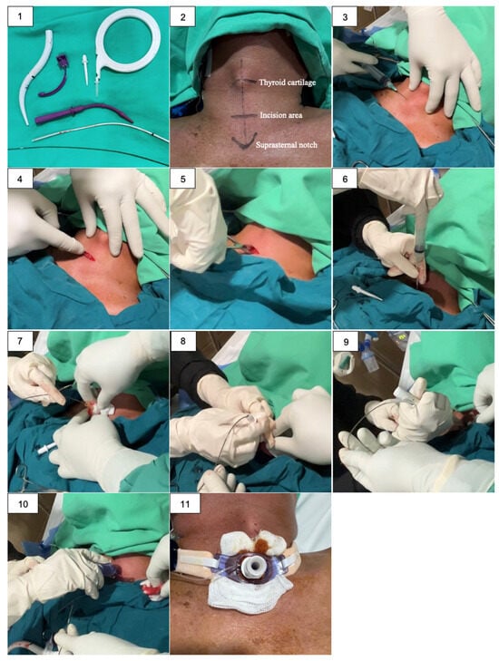 Sequential steps of the bedside Percutaneous Dilatational Tracheostomy (PDT) procedure in the ICU: (1) Preparation of the PDT set and surgical instruments; (2) Identification and marking of anatomical landmarks; (3) Sterilization of the surgical field and infiltration of local anesthesia using 2% lidocaine; (4) Performance of a 1 cm vertical skin incision at the designated puncture site (two finger-breadths below the thyroid notch); (5) Blunt dissection of the subcutaneous tissue to expose the pre-tracheal fascia; (6) Tracheal puncture with the introducer needle, confirming intratracheal placement via air aspiration; (7) Advancement of the guidewire into the tracheal lumen using the Seldinger technique; (8) Initial dilation of the puncture tract using a small dilator; (9) Expansion of the stoma using a large dilator to accommodate the cannula size; (10) Insertion of the tracheostomy tube into the dilated stoma; (11) Final securement of the tube and application of a sterile dressing.