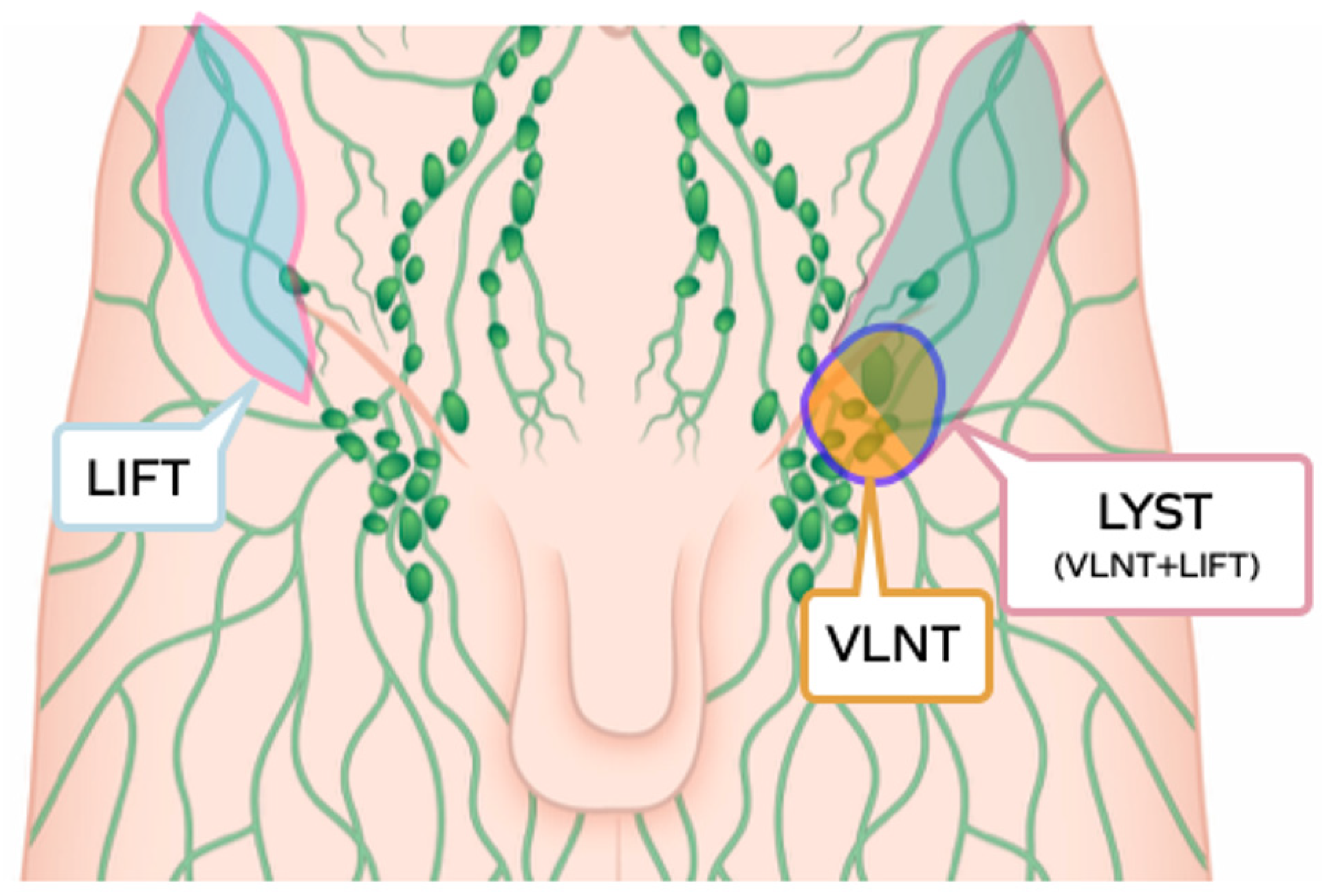 Lymphatic Tissue Transfer: Ultrasound-Guided Description and ...