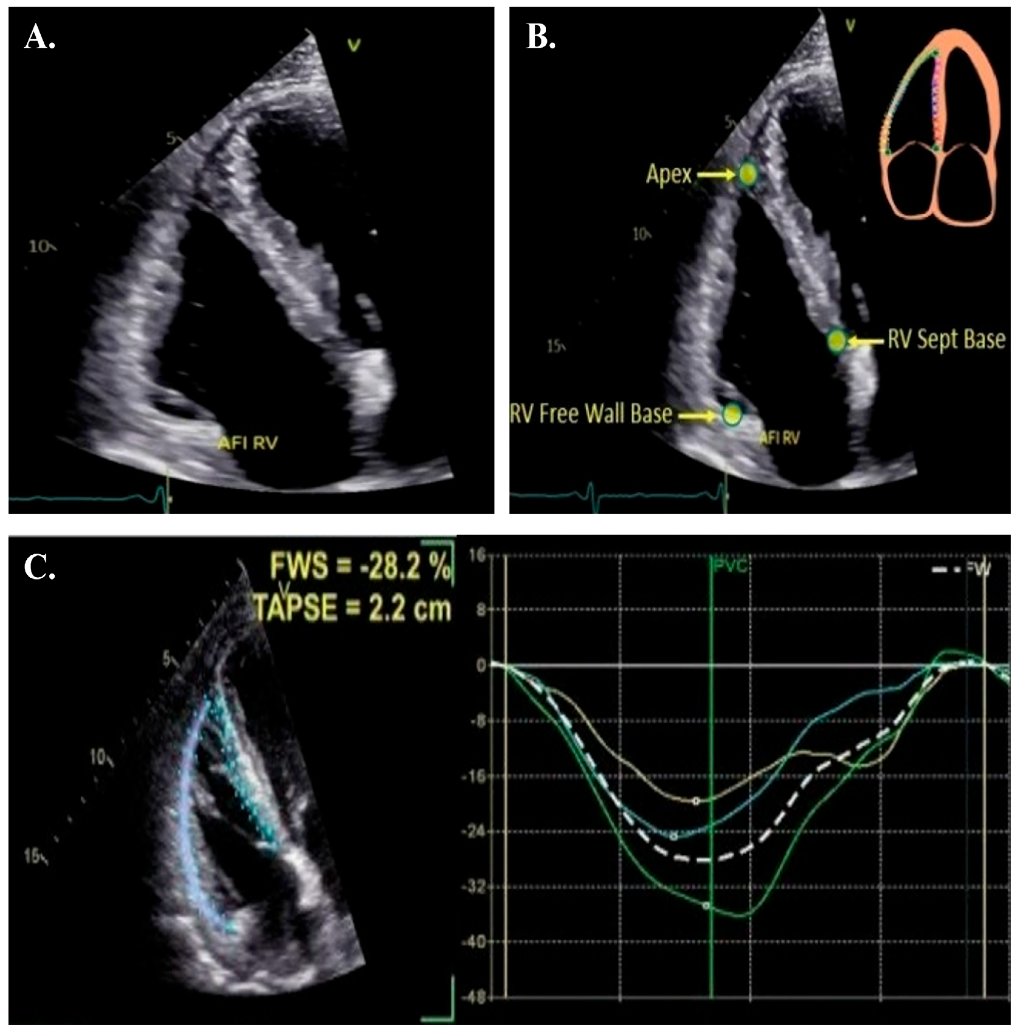 Right Ventricular Strain by Echocardiography: Current Clinical ...