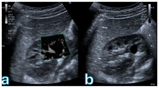 (a) Superb Microvascular Imaging (SMI) of a renal cyst demonstrates no detectable microvascular flow within the thin cyst wall, with absence of septa or mural nodules. (b) Corresponding B-mode ultrasound image shows an anechoic lesion with smooth margins and posterior acoustic enhancement, without any solid components. Overall features are consistent with a simple renal cyst (Bosniak I) according to the 2019 Bosniak classification.