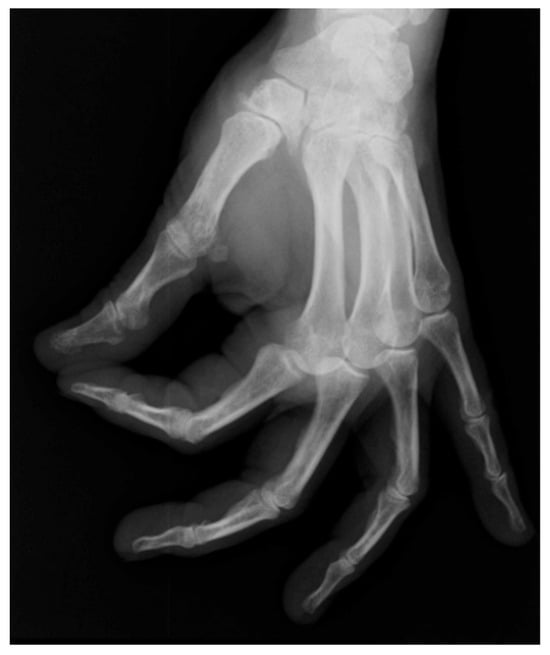 Radiographic image showing rhizarthrosis on a hand X-ray.