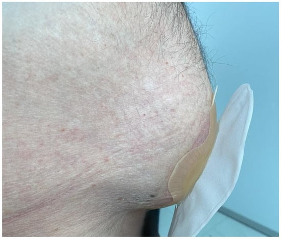 Clinical presentation of parastomal hernia at the ileal conduit stoma site.