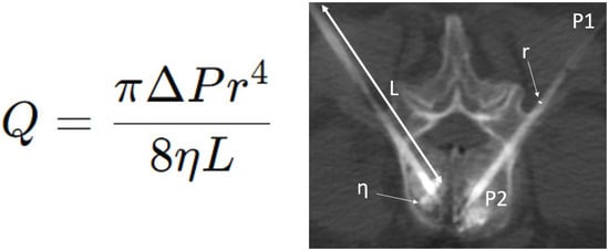 Poiseuille’s law equation (left) and application during a bipedicular L3 cementoplasty (right). Q = volume flow rate (m3/s); r = radius (m); L = length (m); η = fluid of dynamic viscosity (Pa.s); ΔP = pressure difference (Pa) between the two ends of the tube.