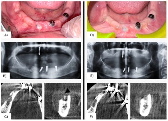 Left mandibular swelling with pus discharge and pain (A) assessed with panoramic radiograph (B) and CBCT (C) which showed a radiolucent area indicative of osteolytic bone destruction. A 6-month clinical-radiographic follow-up showing complete healing of the soft and hard tissues (D–F).