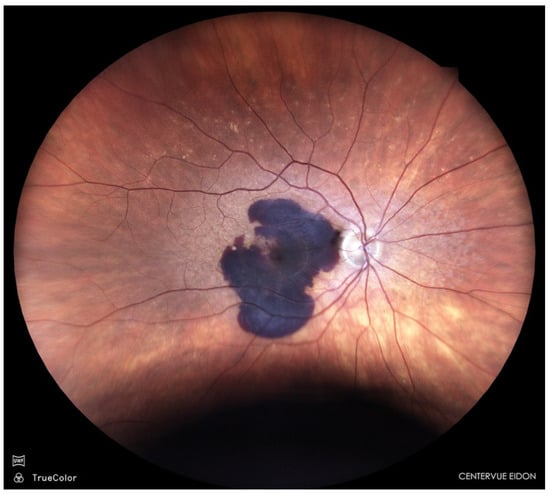Sub-macular haemorrhage in nAMD.
