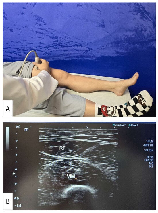 Ultrasonographic assessment of quadriceps muscle thickness. (A) Participant positioned supine with both lower limbs fully extended and relaxed while a physician places the linear transducer at the midpoint between the anterior superior iliac spine and the superior border of the patella. (B) Representative transverse ultrasound image of the quadriceps, showing measurement of quadriceps muscle thickness as the sum of the distance between the rectus femoris (RF) and vastus intermedius (VIM) muscles. The white arrow on the left side of the image indicates the ultrasound focal depth, which was adjusted to optimize visualization of the muscle layers.