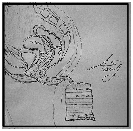 Illustration of the transanal tube (drawn by Maria M. Răvaș).