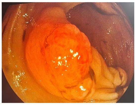 Colonoscopy—semi-pedunculated polyp in the descending colon.
