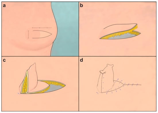 Diagrammatic representation of the long V-Y flap design for nipple reconstruction. (a) The flap base is marked at the planned nipple site, designed with a 1:2.5 width-to-length ratio and a half-fusiform shape, tapering in the middle. (b) The flap is meticulously separated with concurrent elevation of the skin and subcutaneous fat layers. (c) The flap is advanced toward the base and folded to achieve the desired height. (d) Depiction of the flap-folding, highlighting the inward manipulation of sharp rectangular tips at the top using a three-point suture, avoiding cuts that could restrict blood flow.