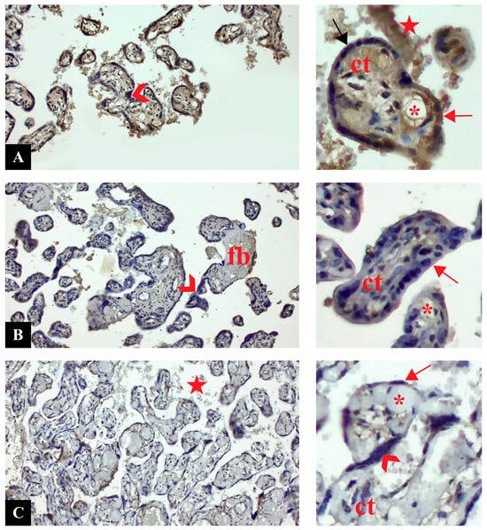 Cross sections of placental tissue. (A): Control. (B): Preeclampsia. (C): Preeclampsia with severe features. NRF1 immunostaining. Insets are higher magnification of sections. Arrow: syncytiotrophoblast cell (red: positive, black: negative), arrowhead: syncytial knot, ct: connective tissue, fb: fibrin deposition, star: intervillous area, *: capillary (Magnification: 20×, scale bar: 50 µm).