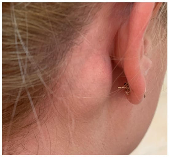 Subcutaneous mass located in the right retroauricular region.