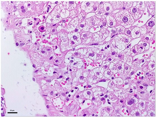 Biopsy fragment 1: Representative histological image of liver tissue stained with Hematoxylin and Eosin (H&E) staining, observed under a 20× objective (total magnification 200×). Scale bar: 50 μm.