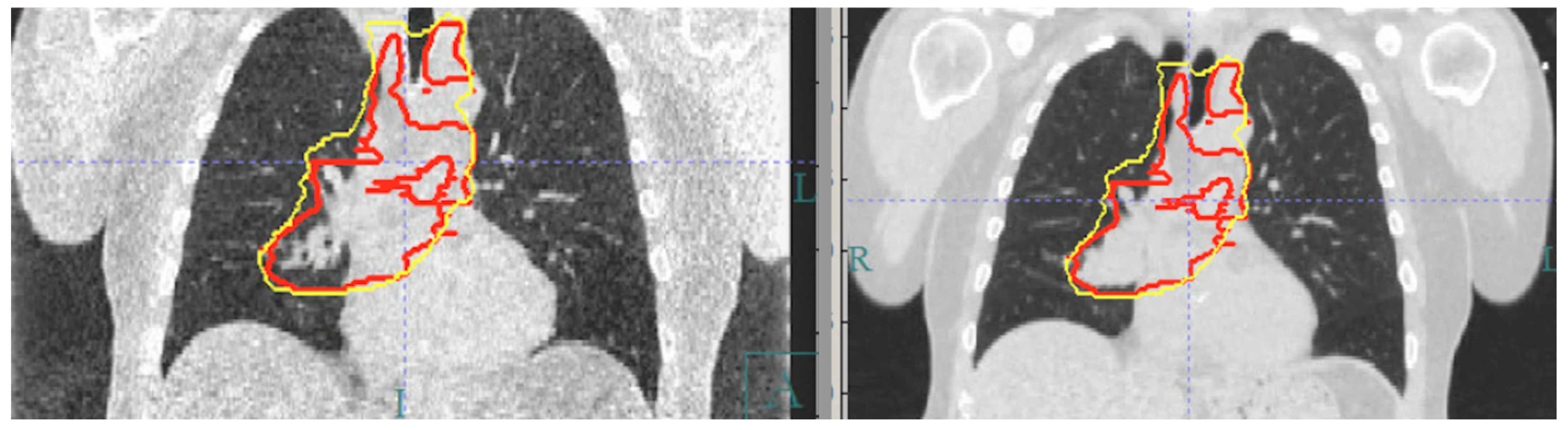 Motion Management: The Road Map to Accurate Radiation Treatment ...