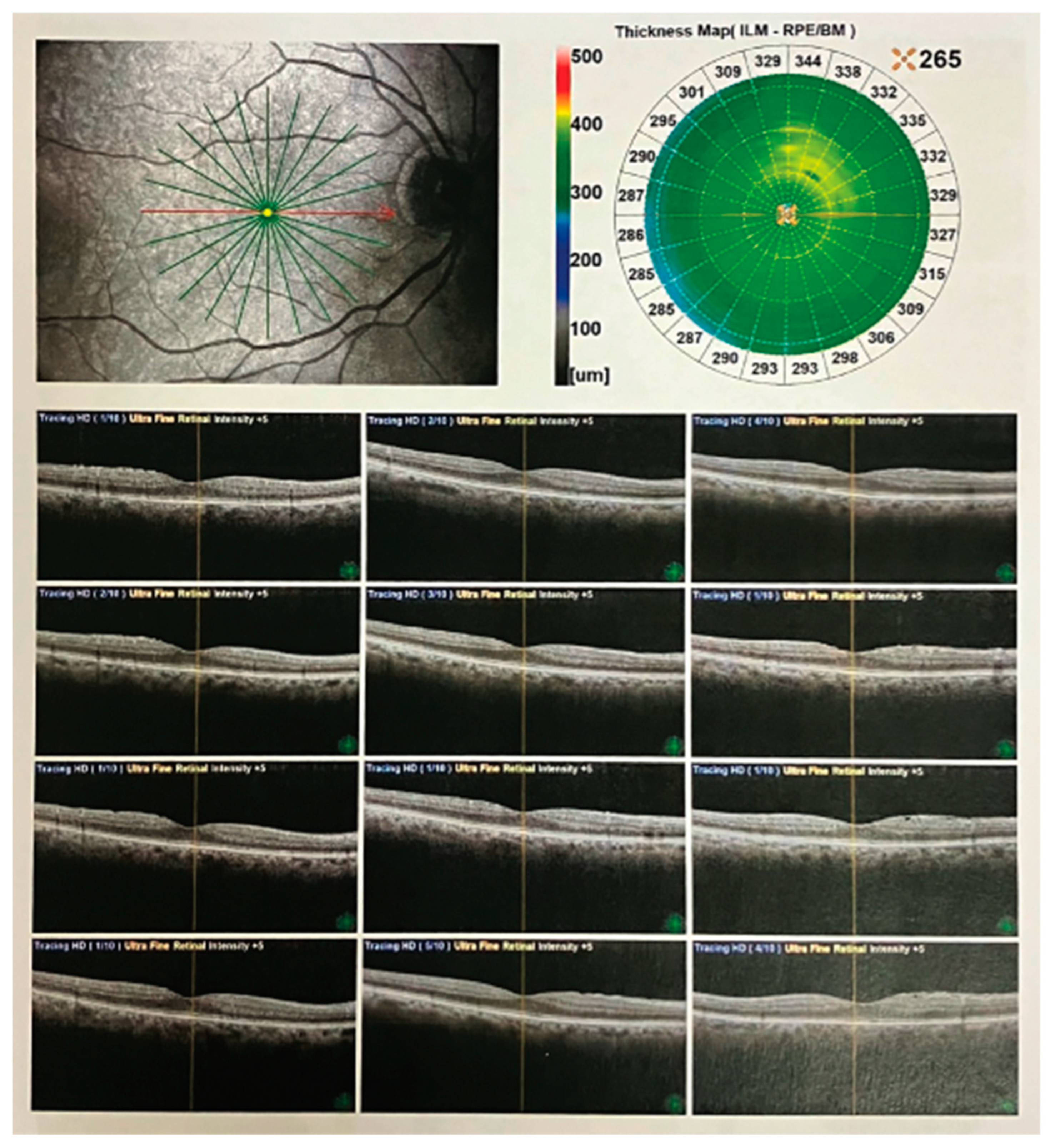 Oct Optometry Options Optical Coherence Tomography (OCT): A Brief Look at the Uses and ...