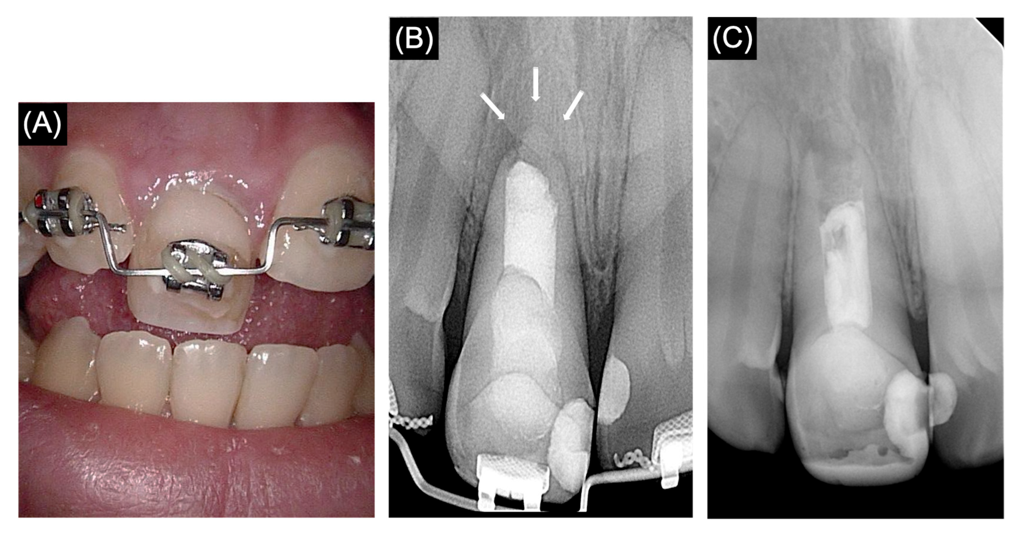 Apexification of an Endodontically Failed Permanent Tooth with an Open ...